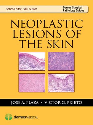 cover image of Neoplastic Lesions of the Skin